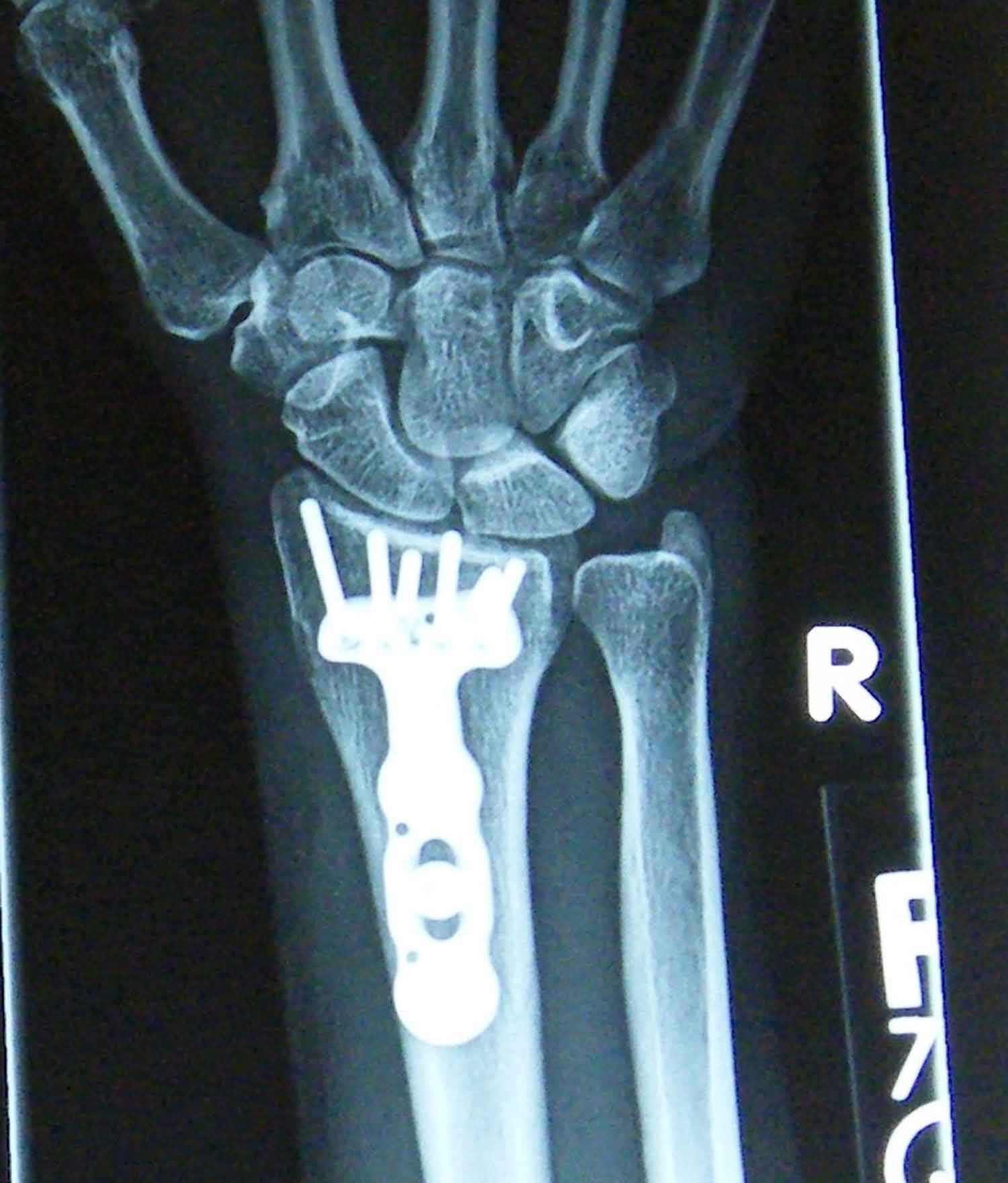 DVR Plate