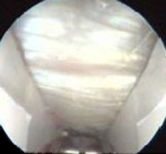 Endoscopic CTR