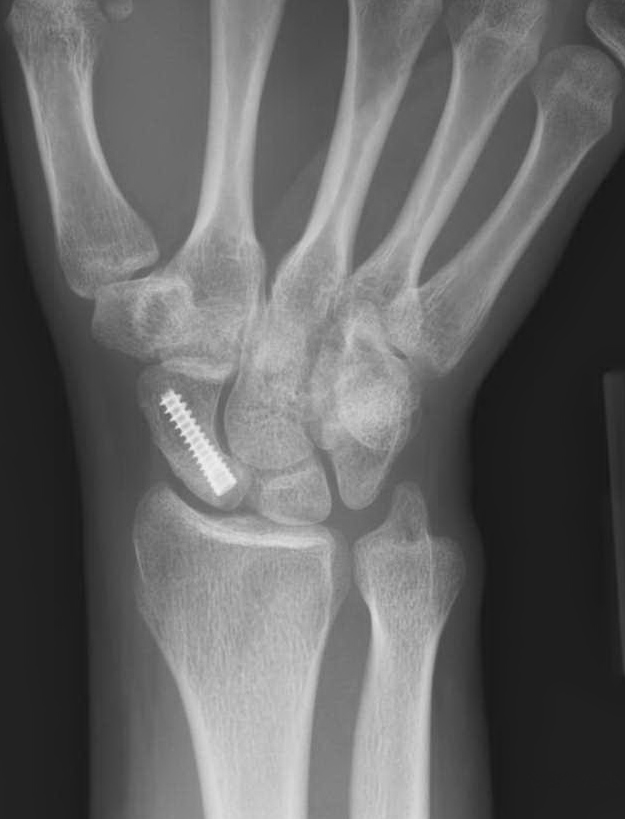 Scaphoid ORIF